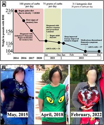 Case report: Ketogenic diet acutely improves cognitive function in patient with Down syndrome and Alzheimer’s disease